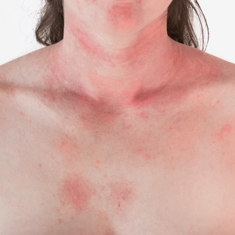 Extremely pruritic rash on the back and chest - Clinical Advisor