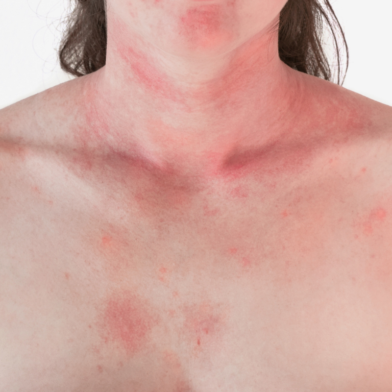 common-viral-skin-rashes