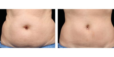 CoolSculpting Promised to Zap Fat. For Some, It Brought Disfigurement. -  The New York Times